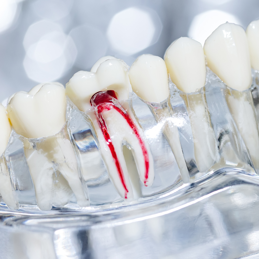 Root Canals in Salt Lake City